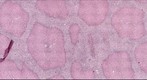 Cirrhosis of human liver