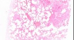 Tuberculosis Sample Slide