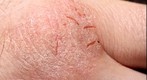 Psoriasis Test