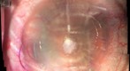 LASIK Flap