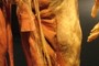 Sciatic Nerve
