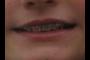 Braces