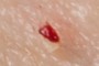 Blood?